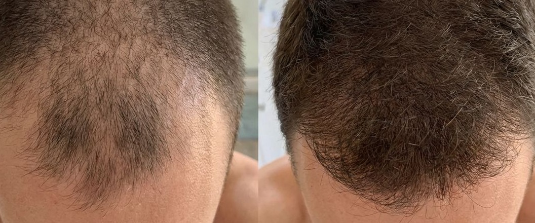 Hair loss alopecia treatment Edinburgh