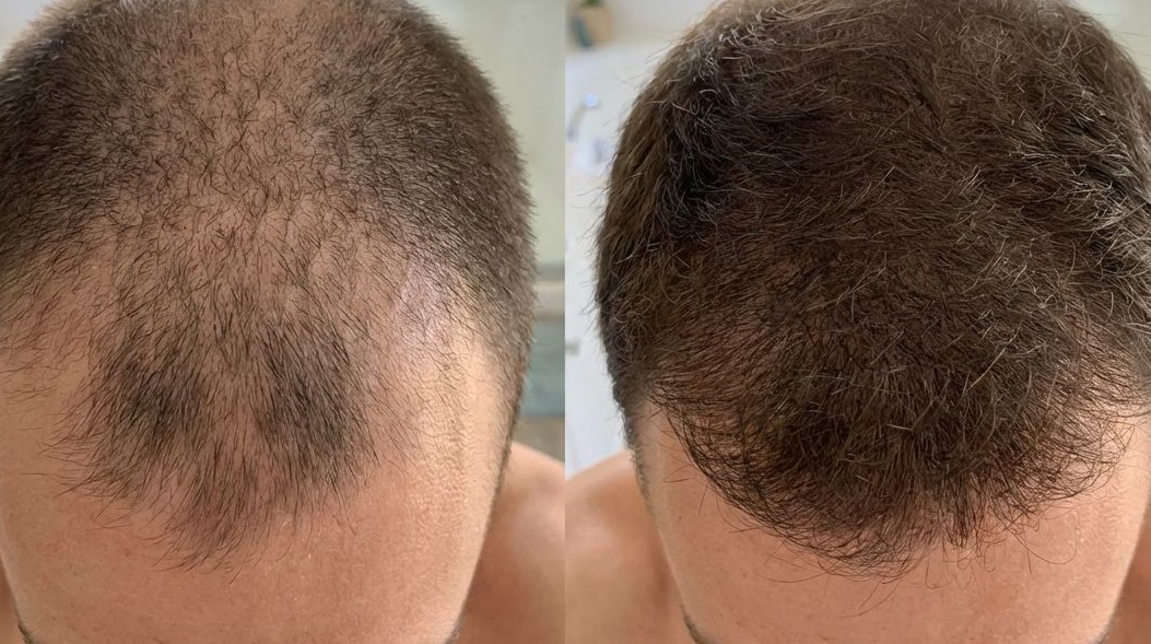 Hair loss consultation process Edinburgh