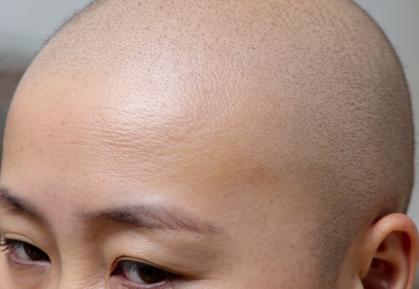 Hair loss consultation Edinburgh