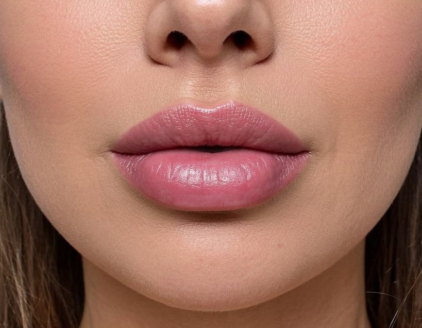 Lip filler treatment Edinburgh