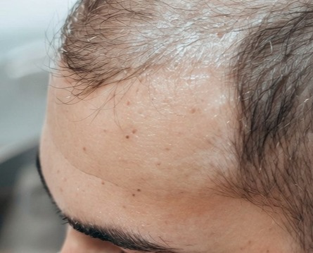 Hair loss consultation at Obsidian Clinics Glasgow
