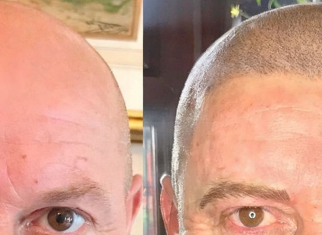 Scalp micropigmentation treatment